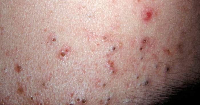 About Acne Lesions