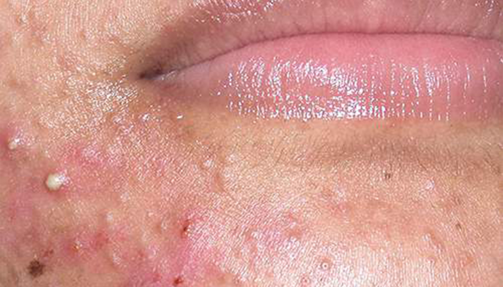 Classificazione dell'acne - Moderata