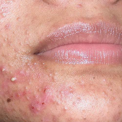 Caso di acne moderata
